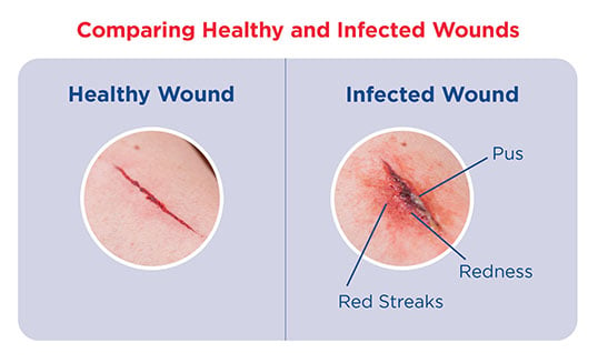 regular skin cut vs infected cut